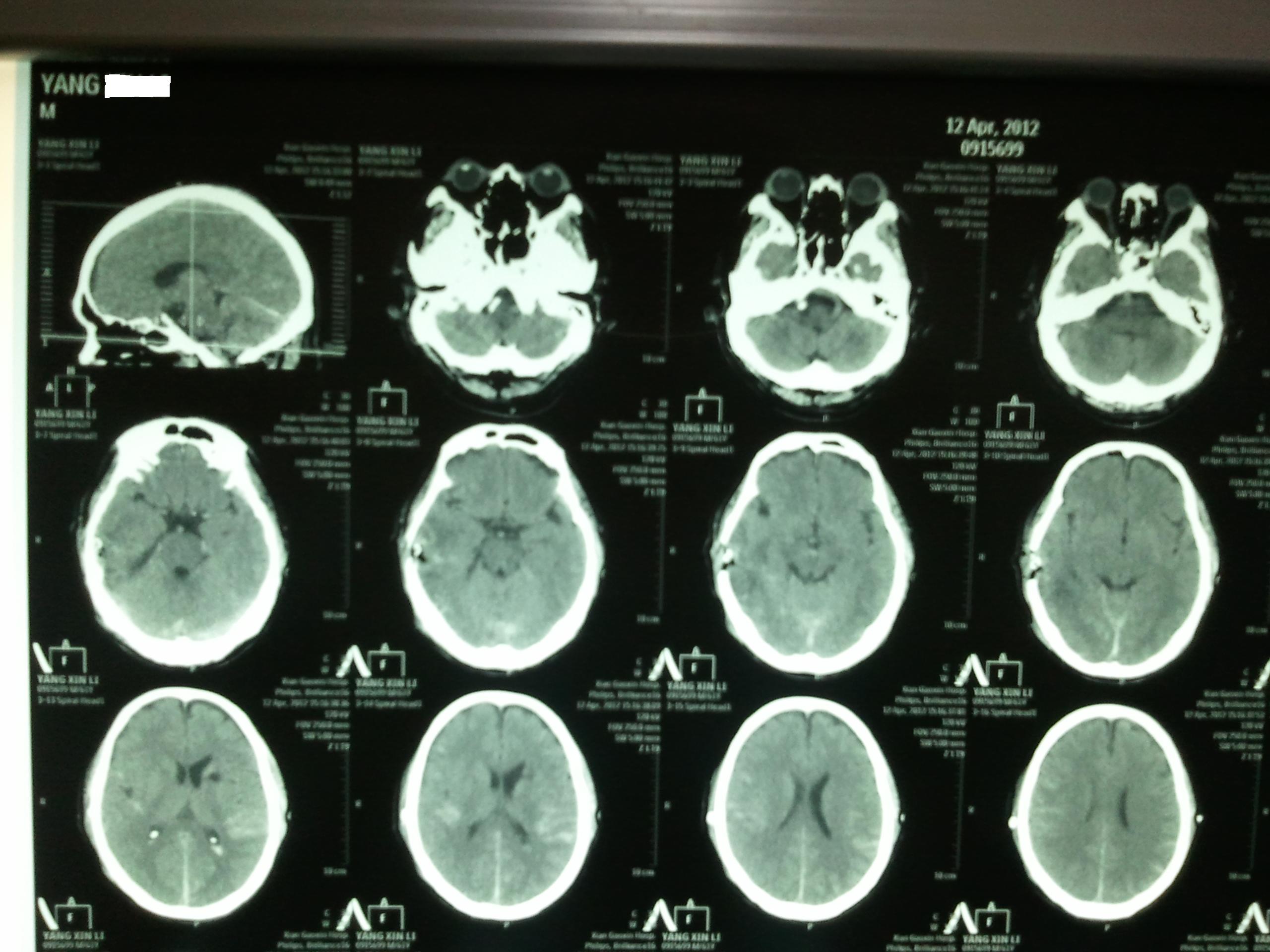 腦內血腫合并糖尿病酮癥、肺部感染微創手術一例體會