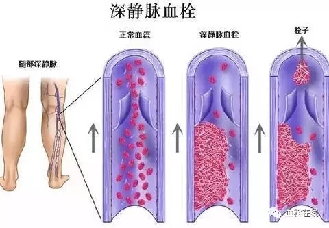 【科普】腿腫，警惕下肢深靜脈血栓形成！