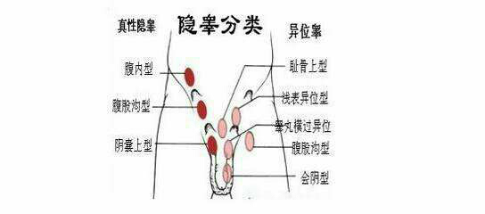隱睪.png